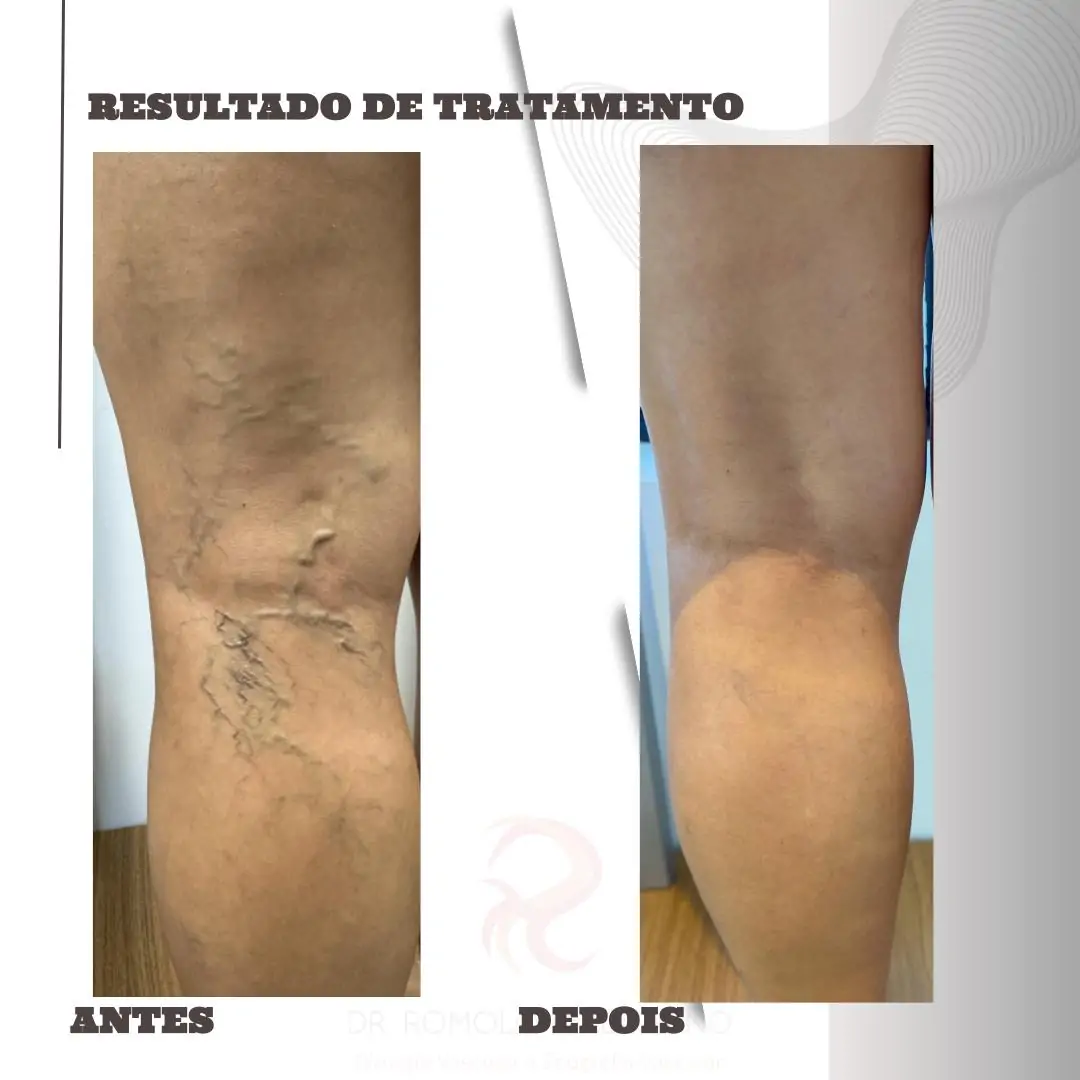 Antes e Depois 2.pptx