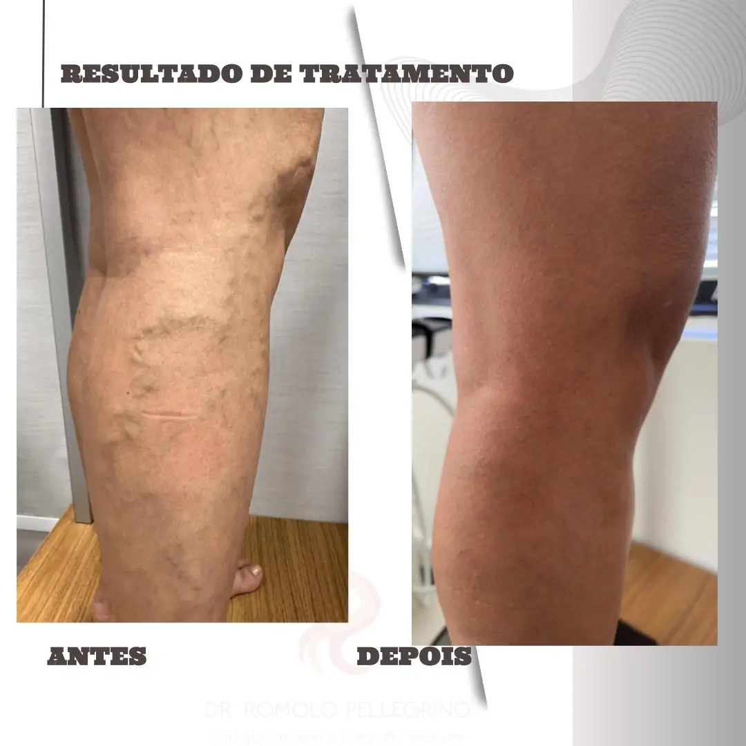 Antes e Depois 3.pptx (2)