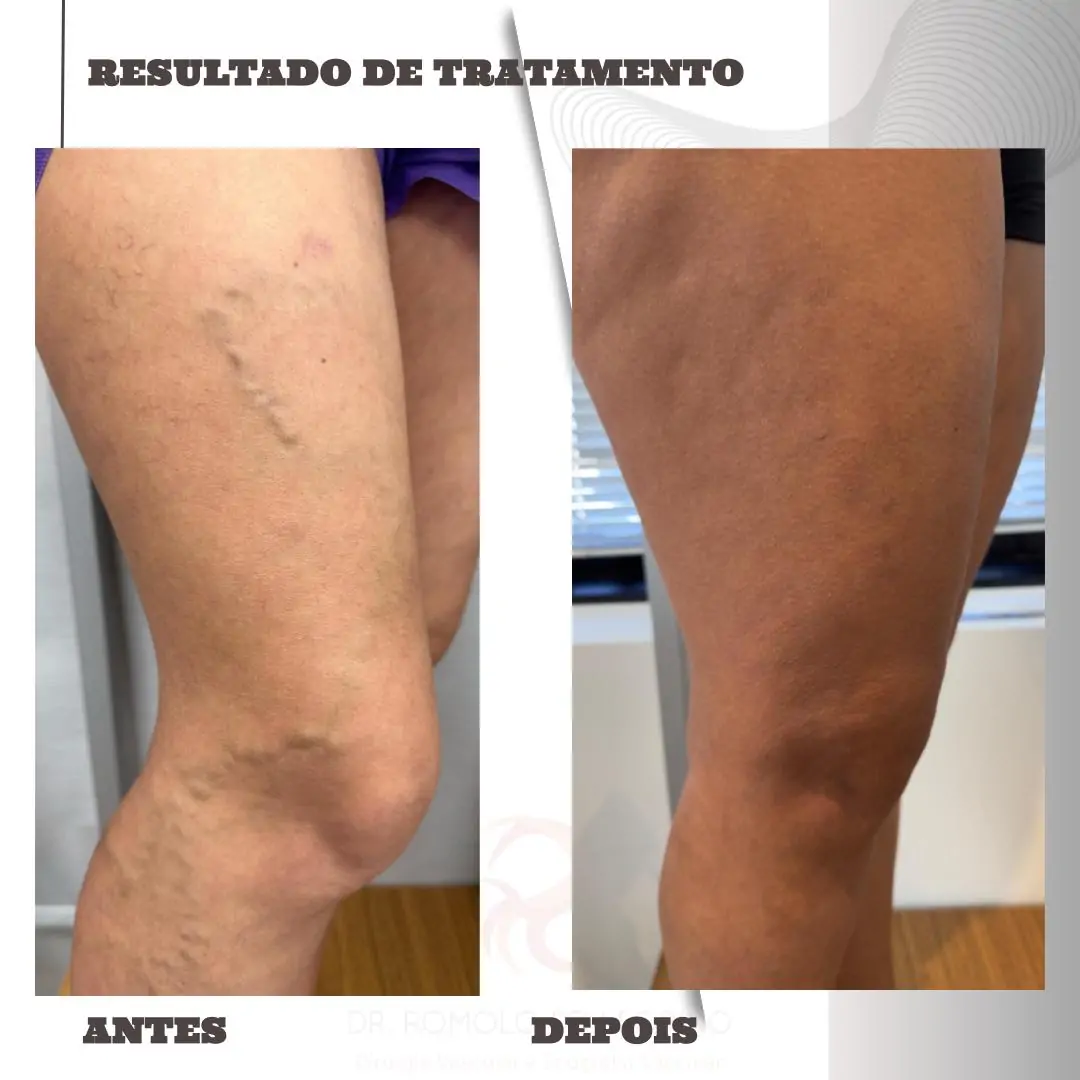 Antes e Depois 3.pptx